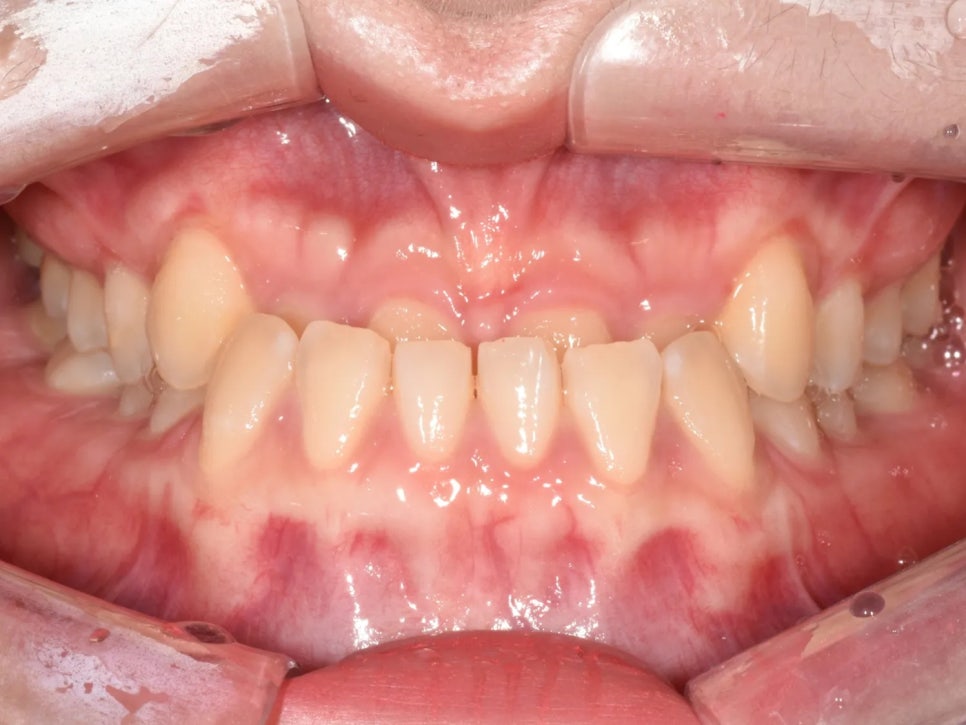 언주역 치과, 주걱턱 + 과개교합을 비수술로 치료한 사례 관련 이미지 3