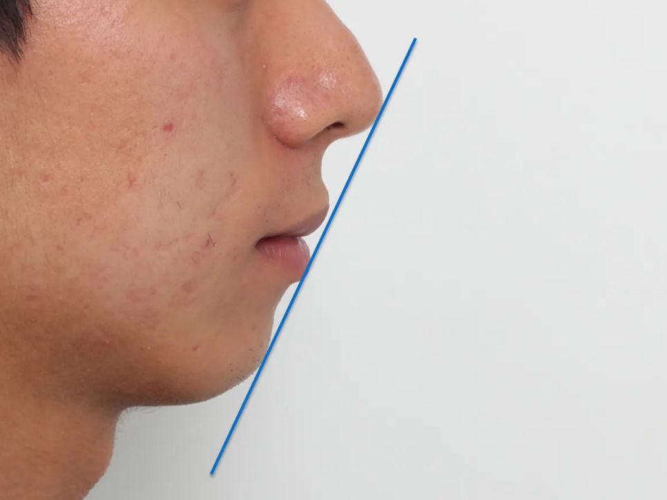 돌출입 교정 전후, 그런데 과개교합까지 있으셨던 환자분 관련 이미지 20