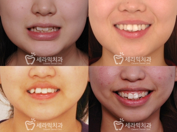 토끼이빨 교정 잘하는곳 강남 세라믹치과! 관련 이미지 2