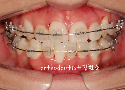 강남 덧니 관련 이미지 19