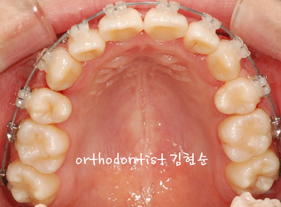 강남 덧니 관련 이미지 20