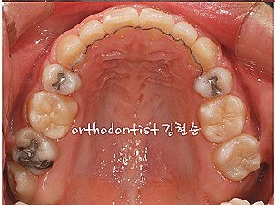 강남 돌출입 교정 관련 이미지 20