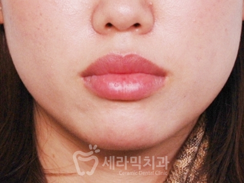 돌출입교정만 했을 뿐인데, 성형한 것처럼 달라진 인상! 관련 이미지 3