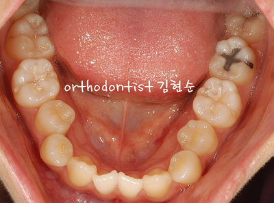 개방 교합 관련 이미지 8