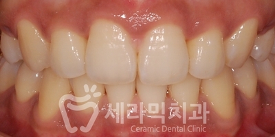 돌출입치아교정 전후사진(발치교정, 토끼이빨 인상변화) 관련 이미지 7