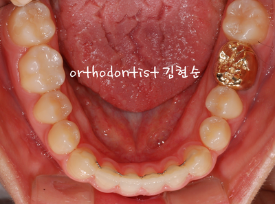 반대 교합 관련 이미지 29