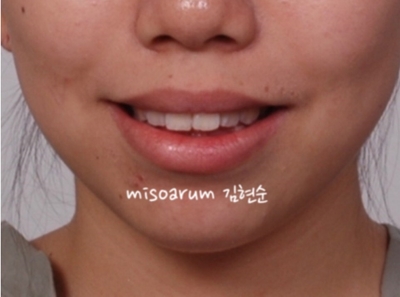 강남치아교정추천 관련 이미지 3