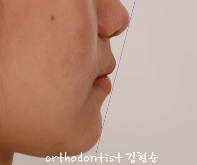 강남 돌출입 교정 관련 이미지 25