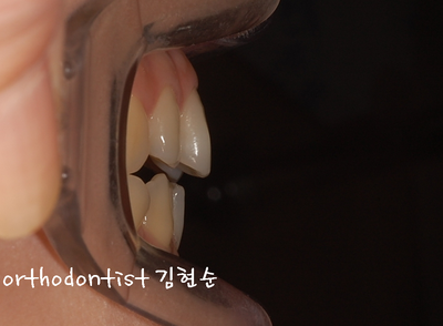 개방 교합 관련 이미지 6