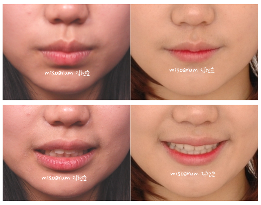 세라믹교정 세라믹치과-돌출입발치교정 9 관련 이미지 6