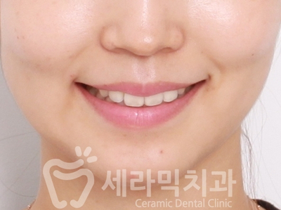 치아교정 전후 확연한 인상 변화! 관련 이미지 9
