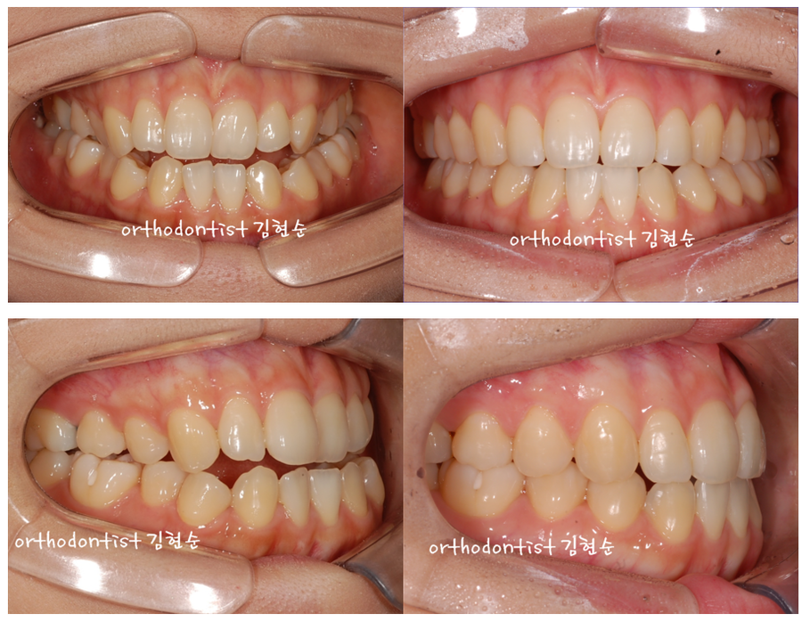 개방교합 비발치 세라믹교정 관련 이미지 13