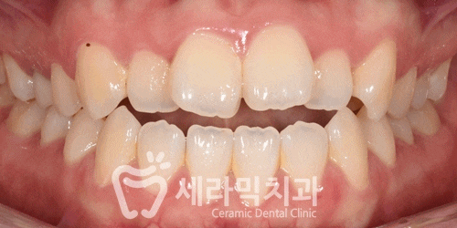 혀내밀기 습관과 개방교합, 오픈바이트(Open bite) 치아교정전후 보기 관련 이미지 10