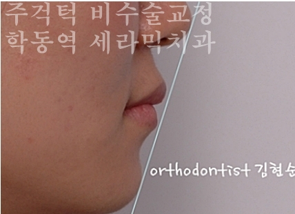 주걱턱 비수술 치아교정 잘하는 학동역 세라믹치과 관련 이미지 8