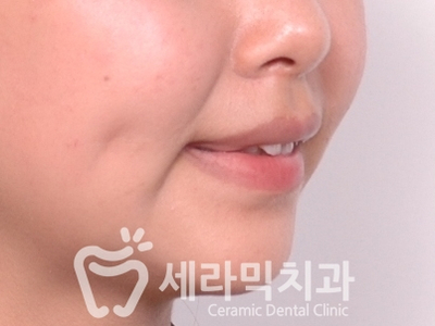 토끼이빨, 틀어진 치아배열 세라믹교정 전후사진 관련 이미지 7