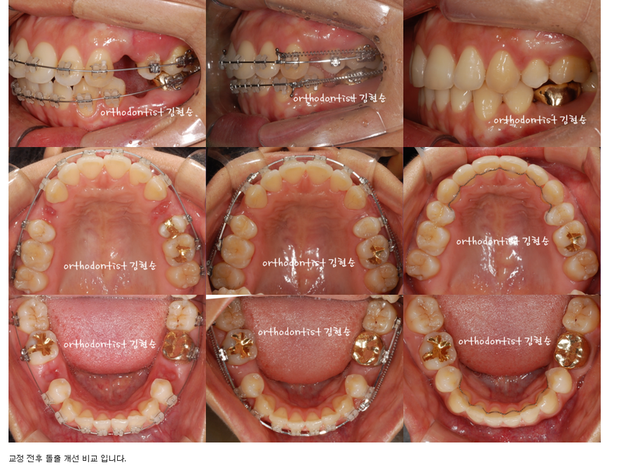 돌출입발치 교정증례 관련 이미지 5