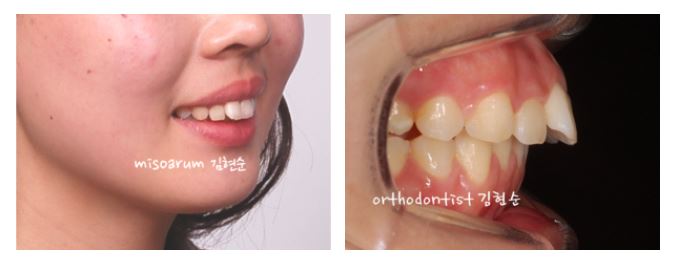 세라믹치과 수술없이 돌줄입교정 관련 이미지 2