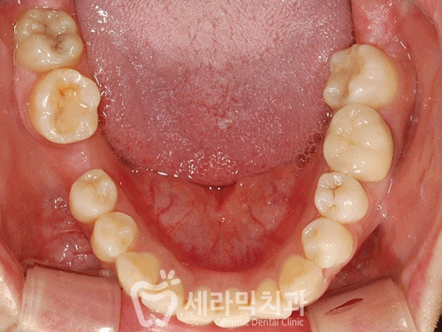 깨진 후에 후회하는 돌출입, 치아교정으로 건강하고 가지런한 치아만들기 관련 이미지 15