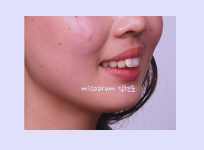 강남 돌출입 관련 이미지 3