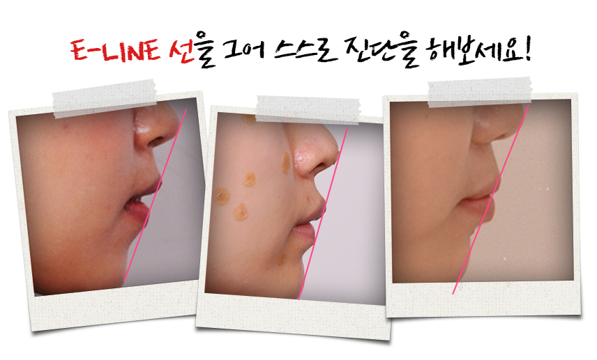 돌출입 비발치 치아교정 관련 이미지 9