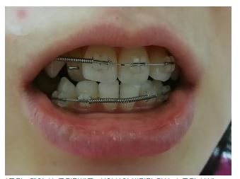 세라믹치과 드라큘라백작 에피소드 2 관련 이미지 2