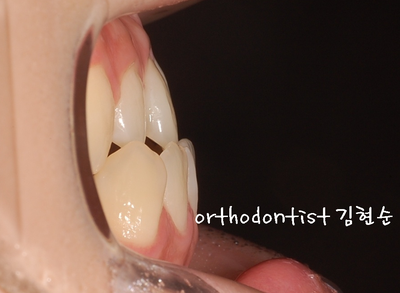 반대 교합 관련 이미지 6