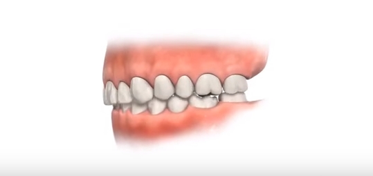 과개교합 ABP 교정 관련 이미지 3