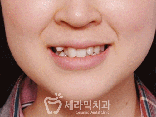 압구정교정치과, 덧니교정 잘하는곳 치아교정전후 관련 이미지 2
