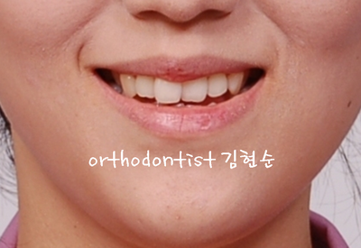 개방 교합 관련 이미지 3