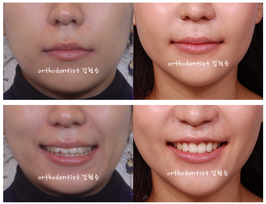 돌출입발치 교정증례 관련 이미지 7