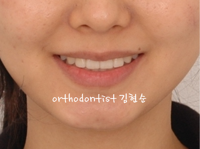 돌출 교정 (비발치 교정/비대칭) 관련 이미지 31