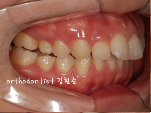 강남 돌출입 교정 관련 이미지 5