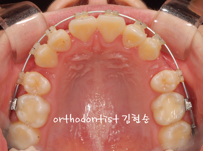 강남 돌출 (토끼 치아) 관련 이미지 20