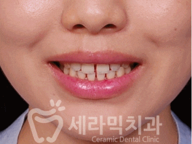 벌어진 앞니, 치아 사이 공간 교정 잘하는 세라믹치과 관련 이미지 6