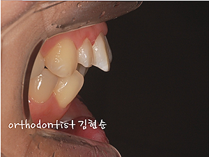 강남 돌출입 교정 관련 이미지 9