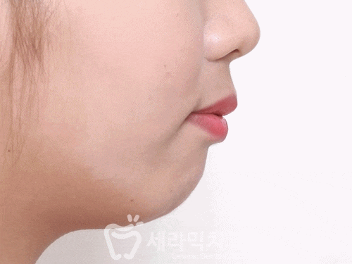 돌출입 치아교정전후 세련된 옆라인을 되찾다! 관련 이미지 1