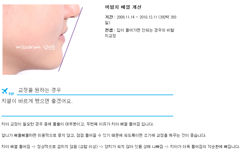 치아의 배열을 개선, 발치하지 않고 교정하기 관련 이미지 3