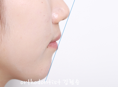 강남 돌출 관련 이미지 36