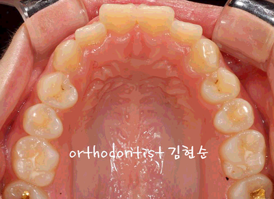 강남 돌출 관련 이미지 9