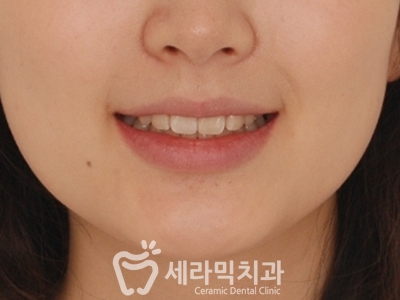 토끼이빨 돌출입 치아교정 전후 표정변화! 관련 이미지 14