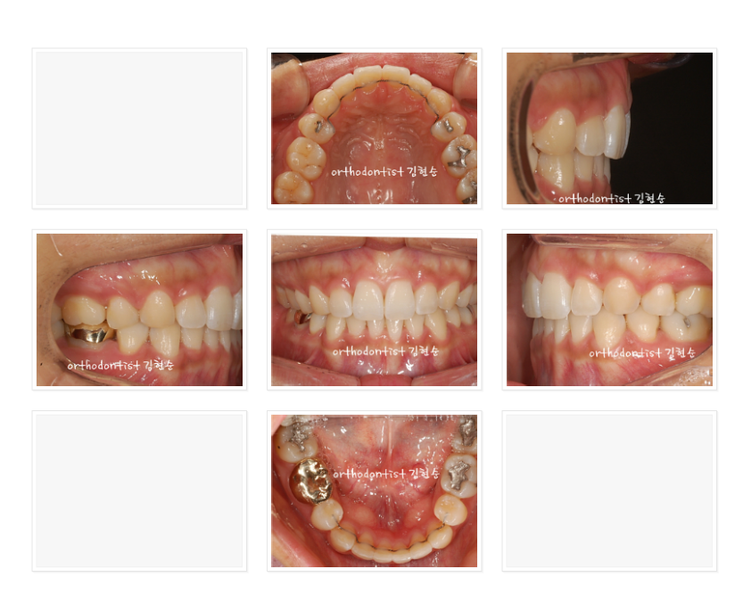 세라믹교정 세라믹치과-돌출입발치교정 7 관련 이미지 6