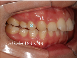 강남 돌출입 교정 관련 이미지 24