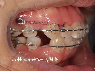 강남 돌출 관련 이미지 25