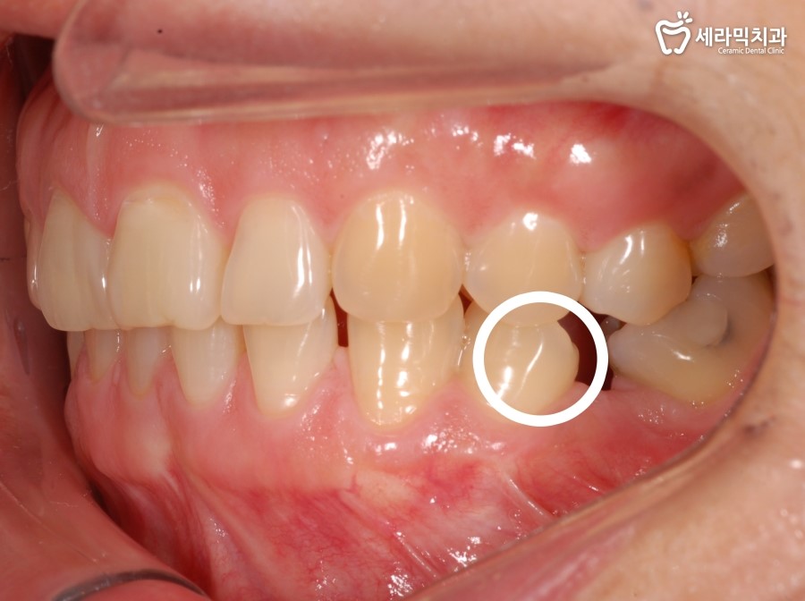세라믹치과 앞니부분교정 관련 이미지 6