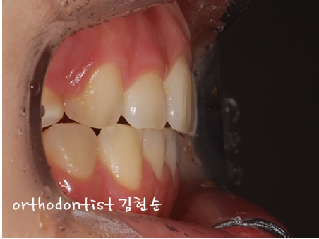 강남 돌출입 교정 관련 이미지 33