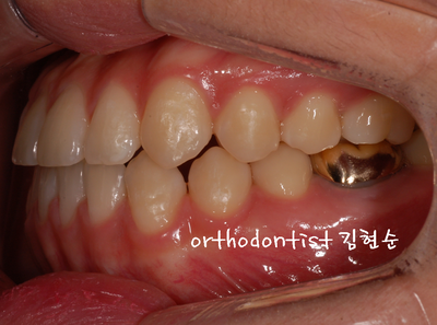 반대 교합 관련 이미지 27