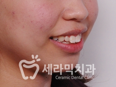 돌출입 잇몸노출 치아교정 전후 인상변화 사례 관련 이미지 7