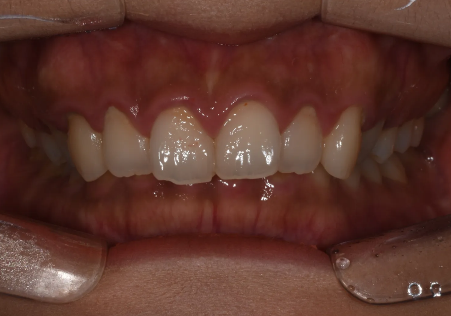 과개교합 교정: 비수술로 치료한 토끼 이빨 이야기 관련 이미지 2