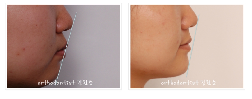 세라믹교정 은 세라믹치과 발치비발치 해결 관련 이미지 10