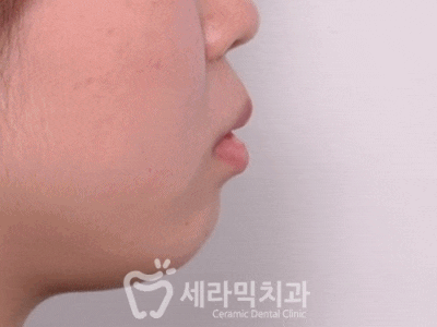 강남치아교정잘하는곳, 돌출입 발치교정 전후 관련 이미지 1